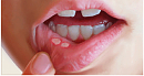 Click image for larger version

Name:	6-Natural-Home-Remedies-for-Canker-Sores.png
Views:	0
Size:	256.0 KB
ID:	756518